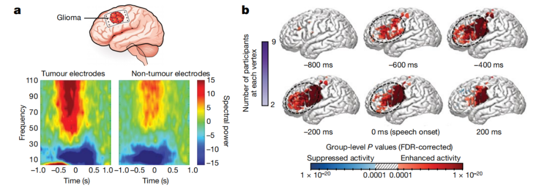 Nature颠覆性发现：大脑思考，促进肿瘤生长！胶质瘤通过劫持神经元影响认知和生存