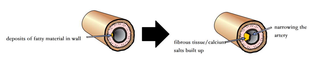 爱徳思生物Cardiovascular disease, CVD深度解析